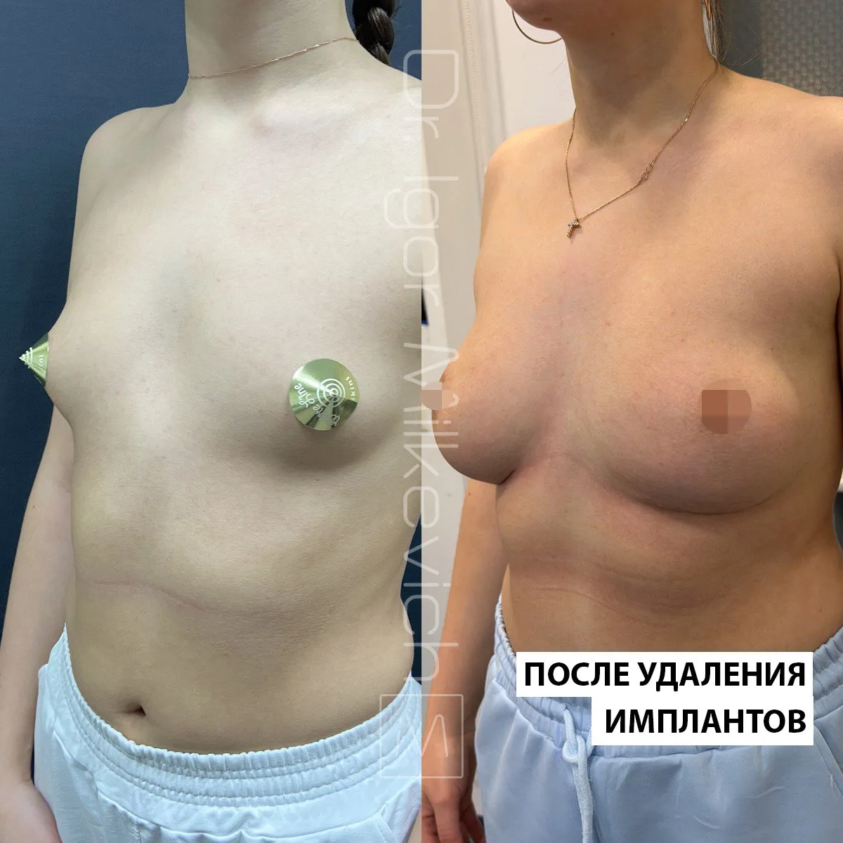 Очень интересный случай. На видео и на первых фото моя пациентка спустя 5 лет после уве...