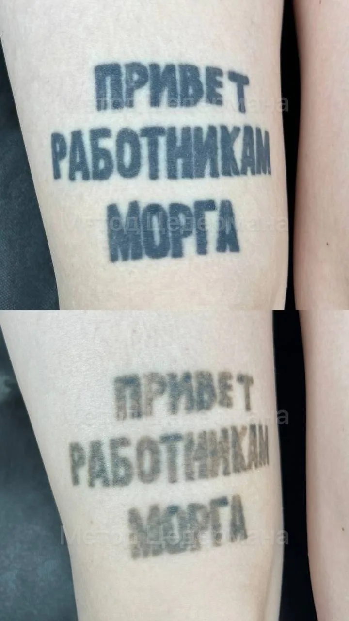 РЕЗУЛЬТАТ 2 ПРОЦЕДУР УДАЛЕНИЯ ПО МЕТОДУ ЦЕДЕРМАНА