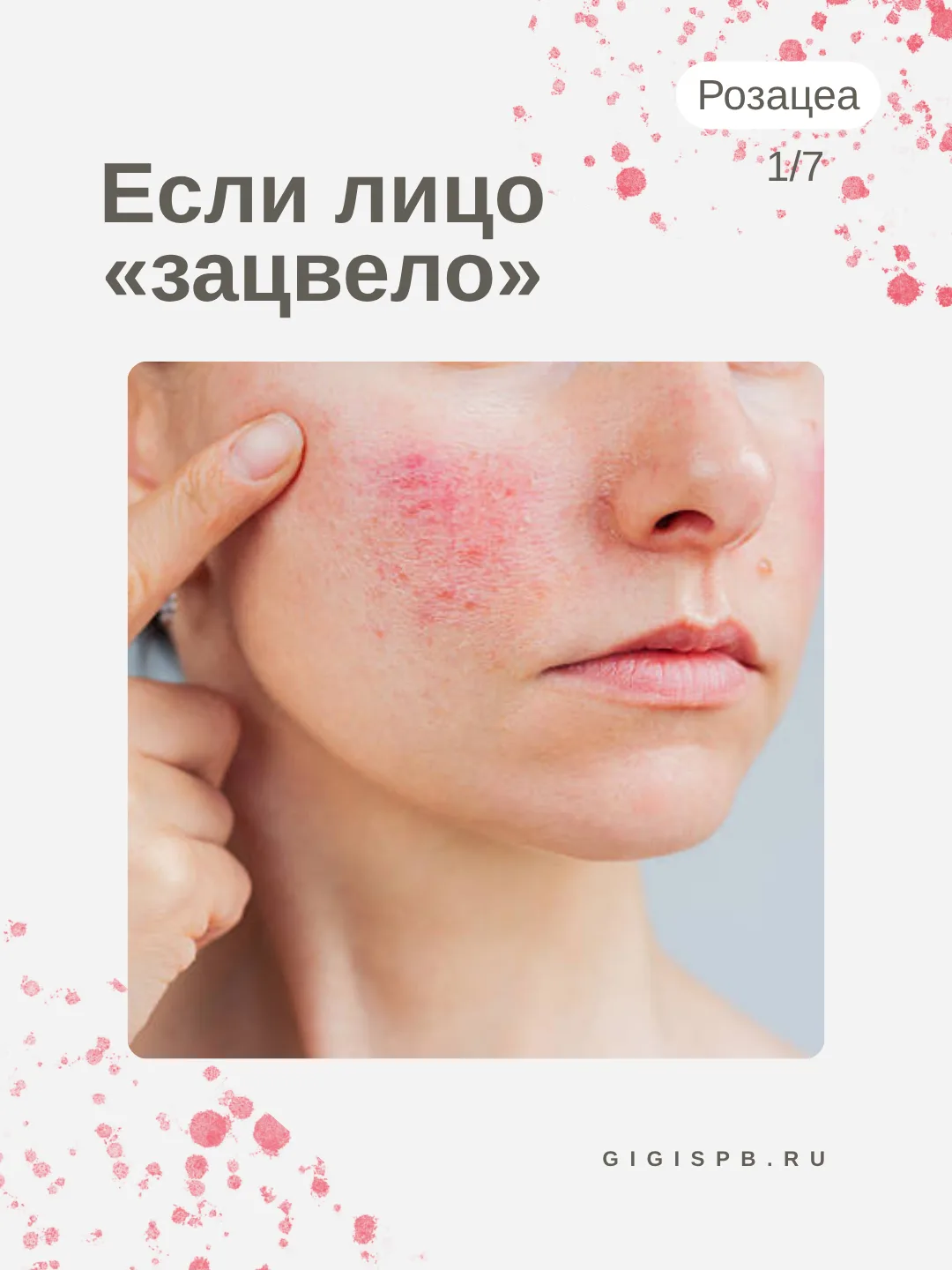 Как нужно ухаживать за кожей с розацеа?