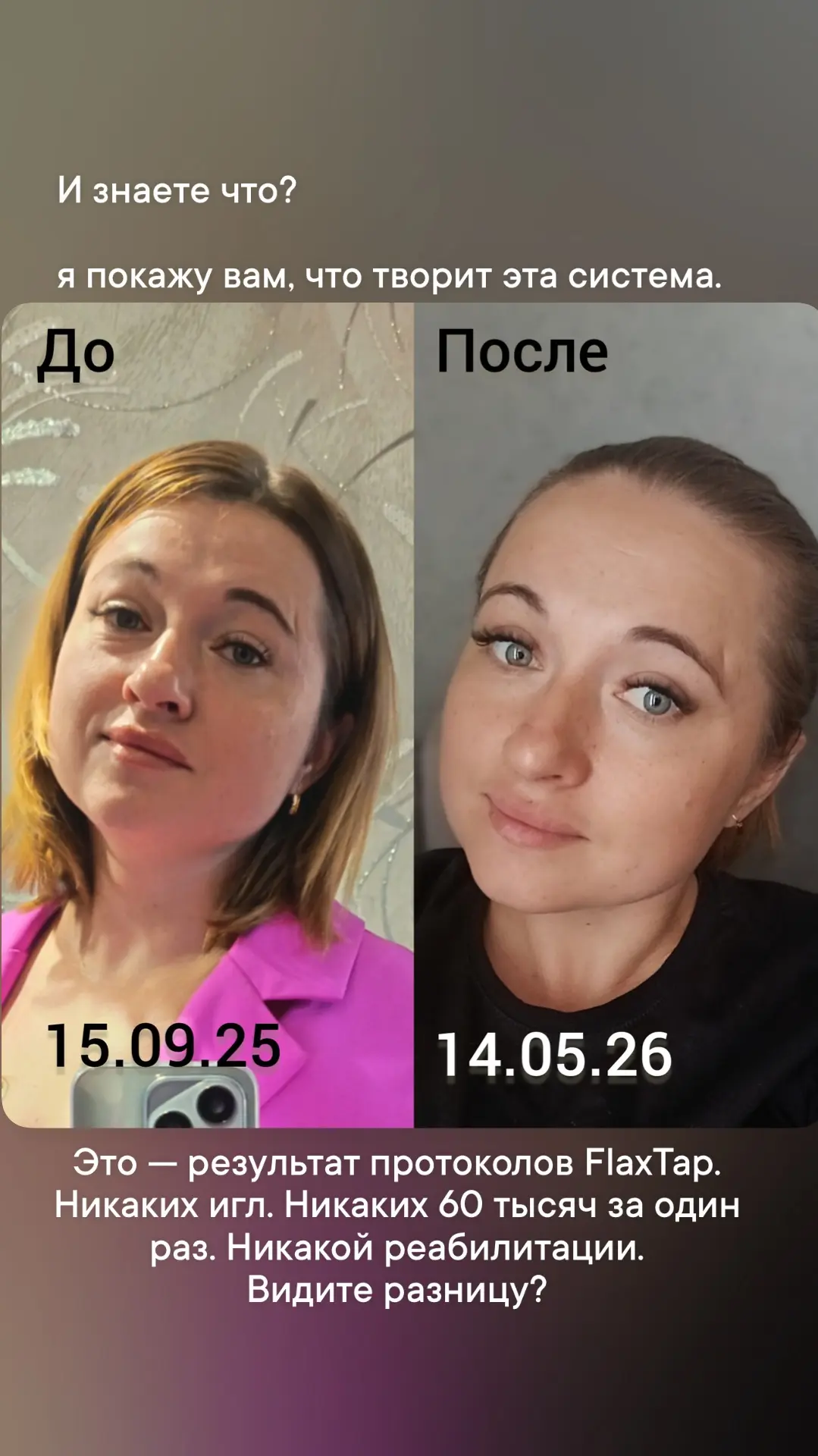 60 000 ₽, иглы, боль и ноль результата. Зачем?
