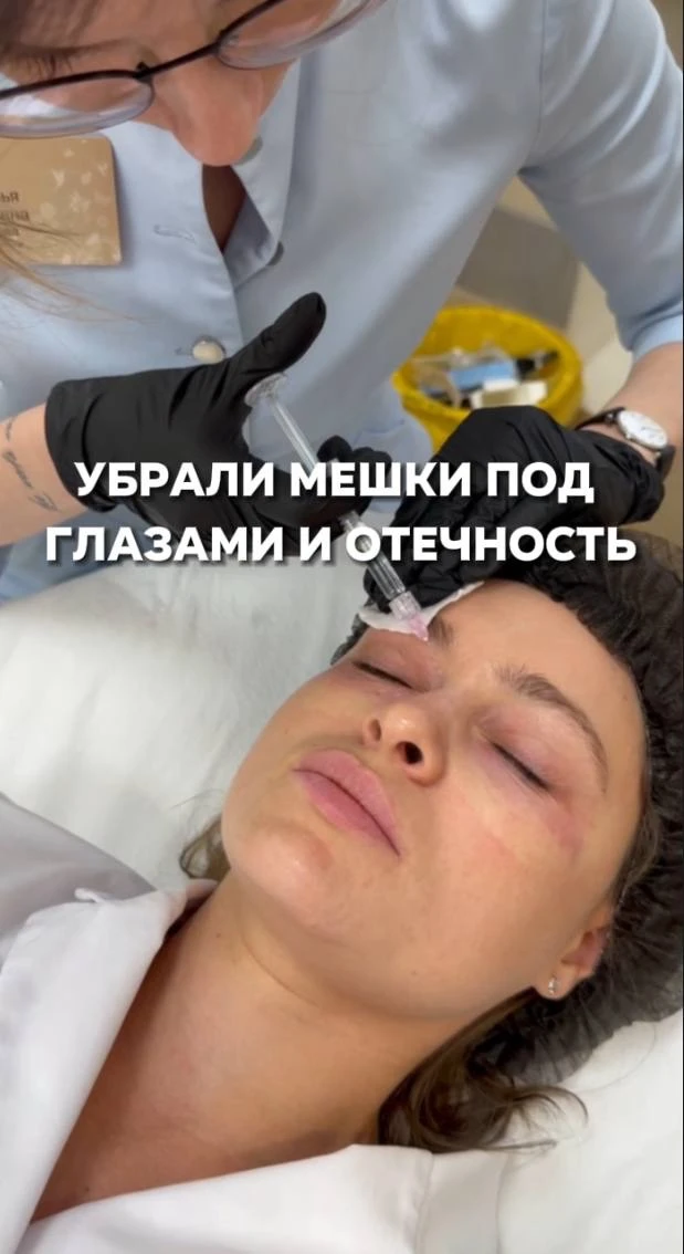 Устранили мешки под глазами за 1 сеанс 😱