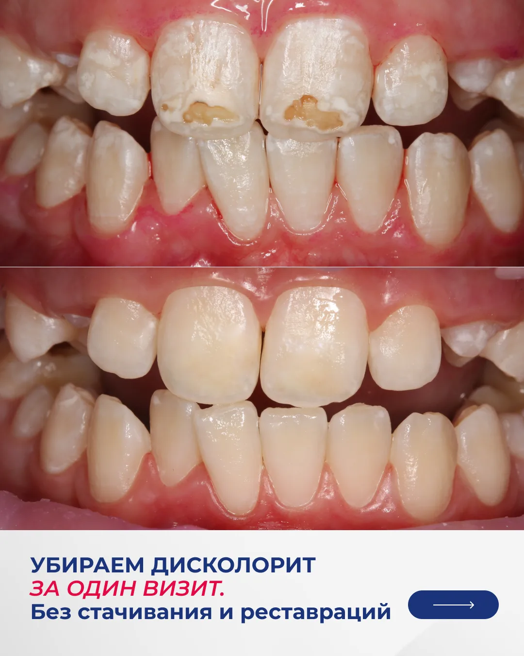 Если на зубах имеется дисколорит, то исправить его можно с помощью одной очень эффектив...