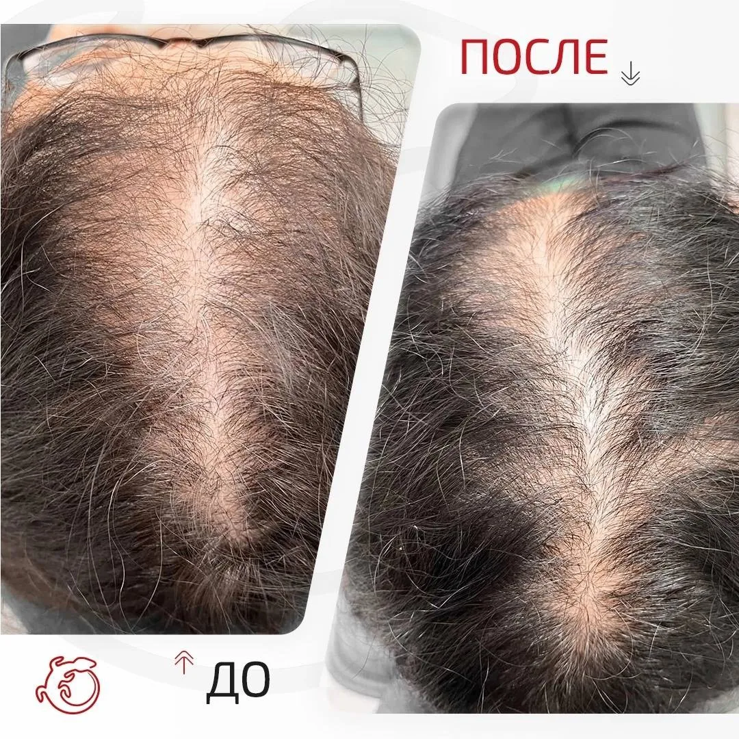 Пациентка, 42 года. 
Диагноз — андрогенетическая алопеция. Проводимое лечение в течение нескольких л