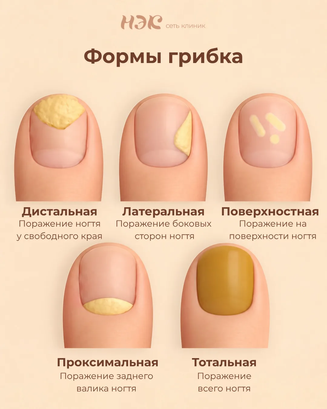 Онихомикоз (грибок) бывает разным. 

И то, как он выглядит, зависит от того, где поселился грибок и 