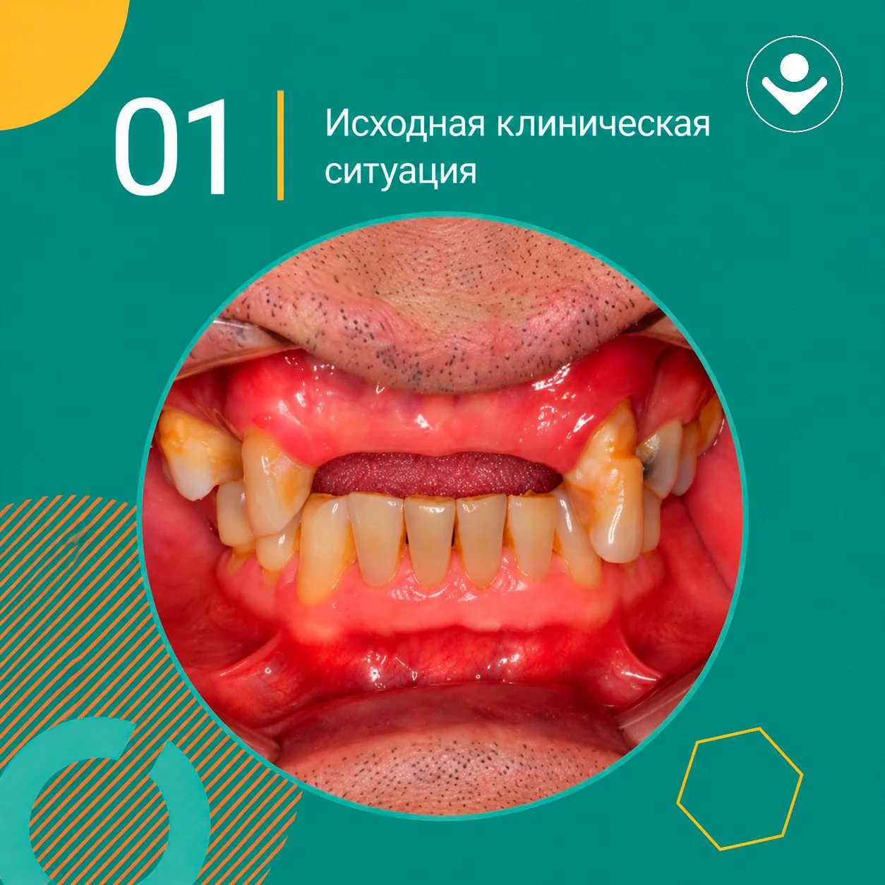 Кейс на NUVO по замещению зубов верхней челюсти гибридным протезом с опорой на импланта...
