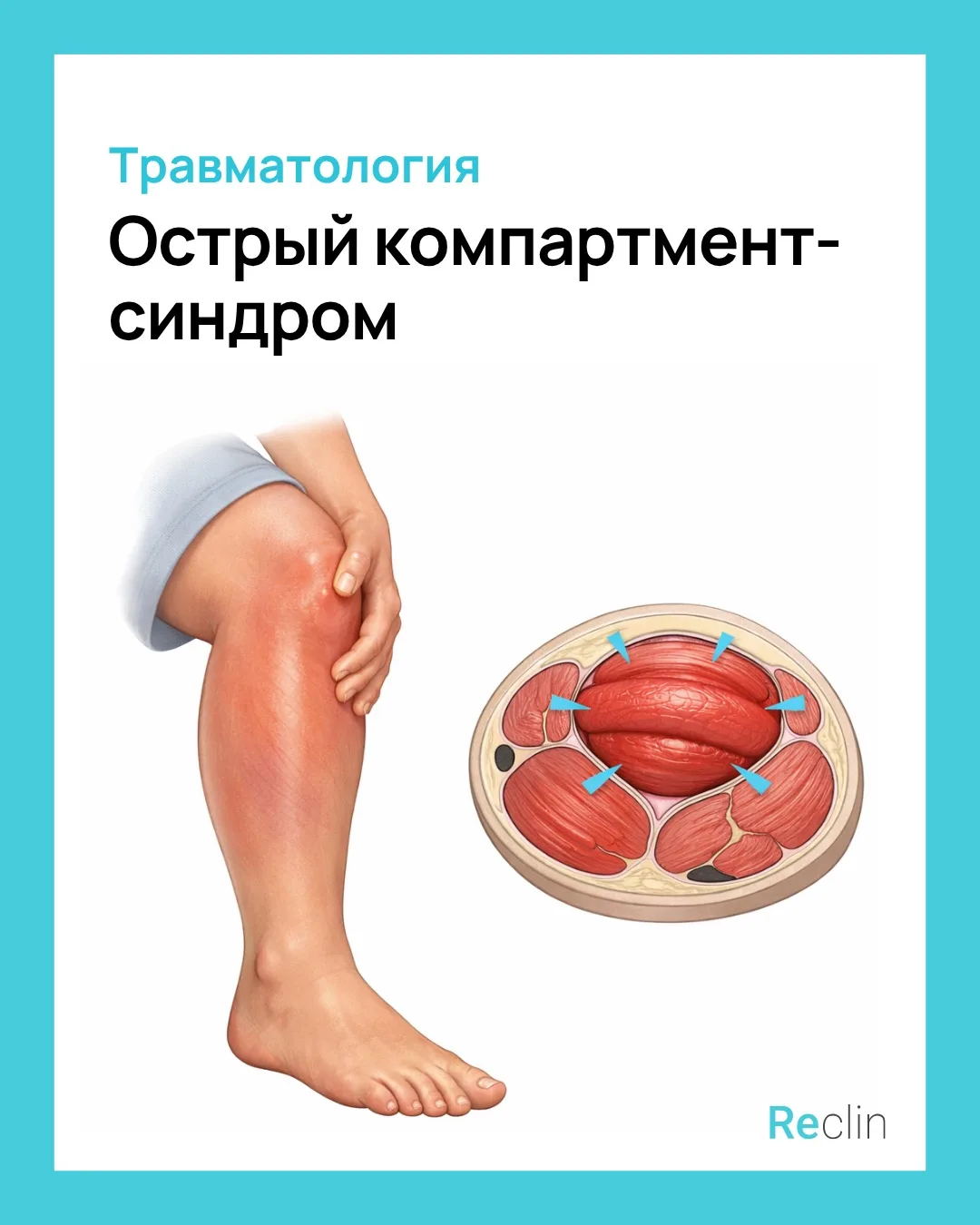 💥 ОСТРЫЙ КОМПАРТМЕНТ-СИНДРОМ 💥