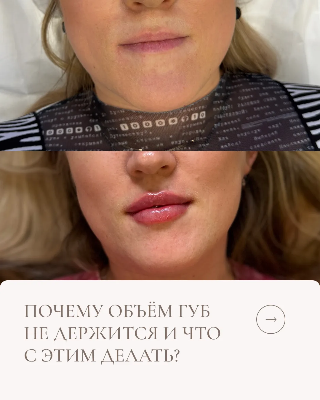 Объём губ не держится и это не приговор 👄