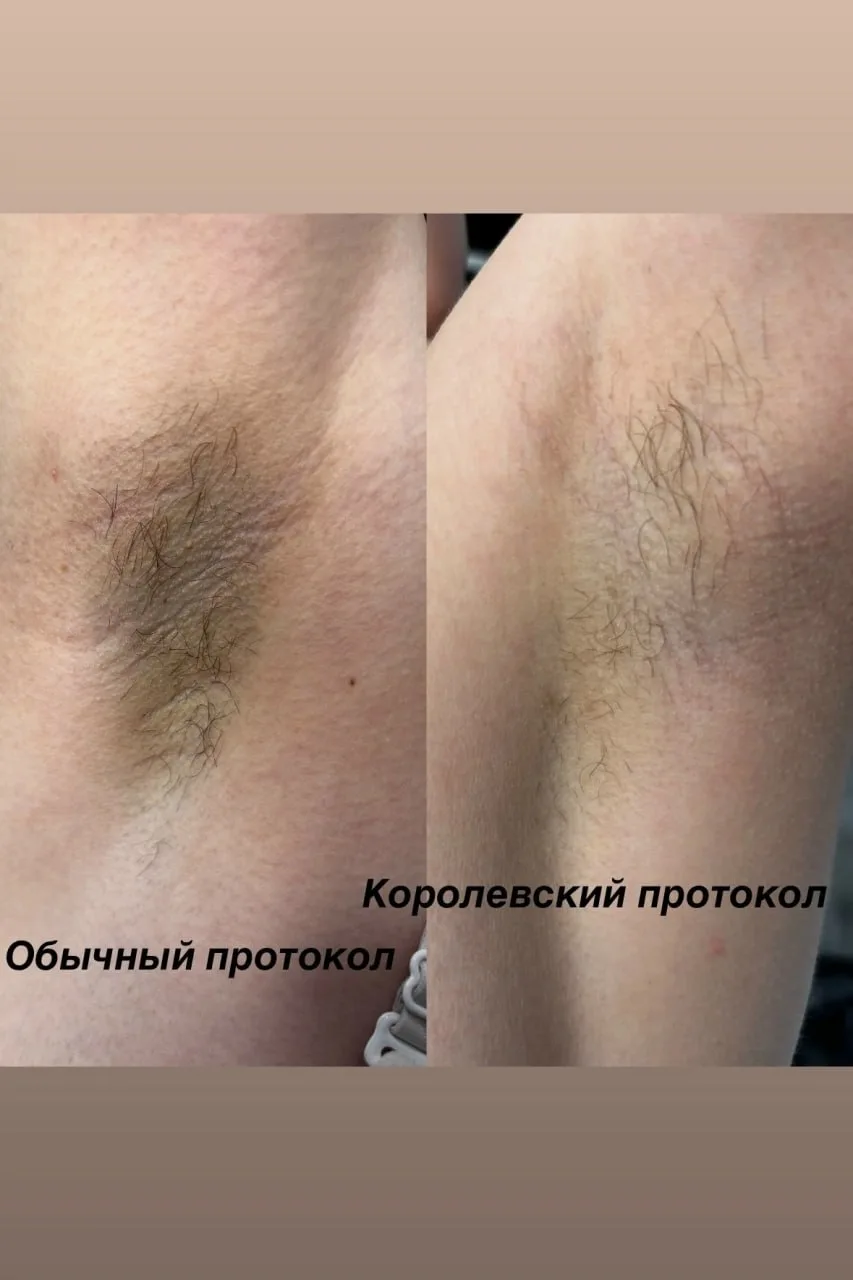 Новый уровень гладкости с «Королева Лазеров» 👑✨