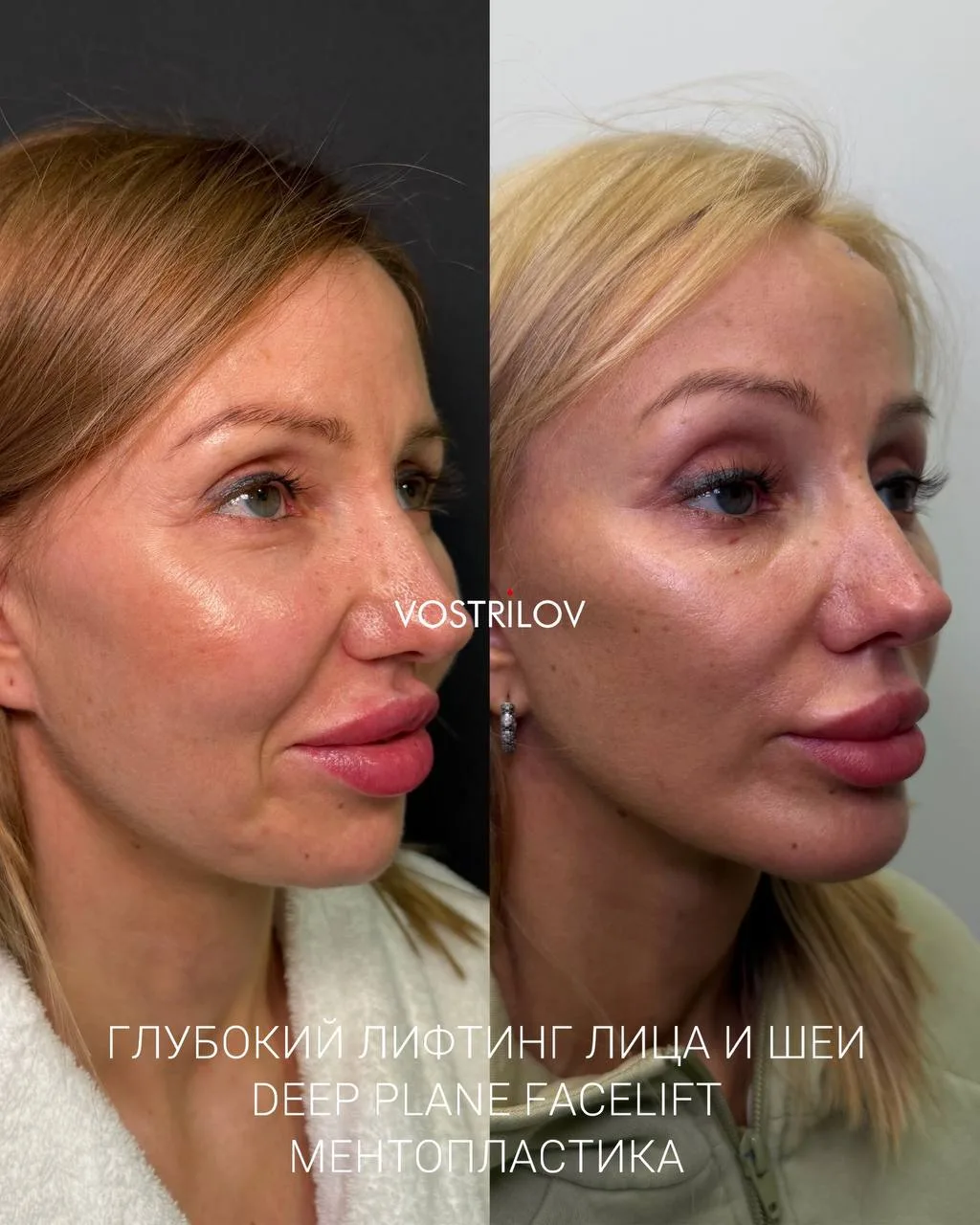 Идеальный результат после омоложения лица и шеи, а также увеличения проекции подбородка...