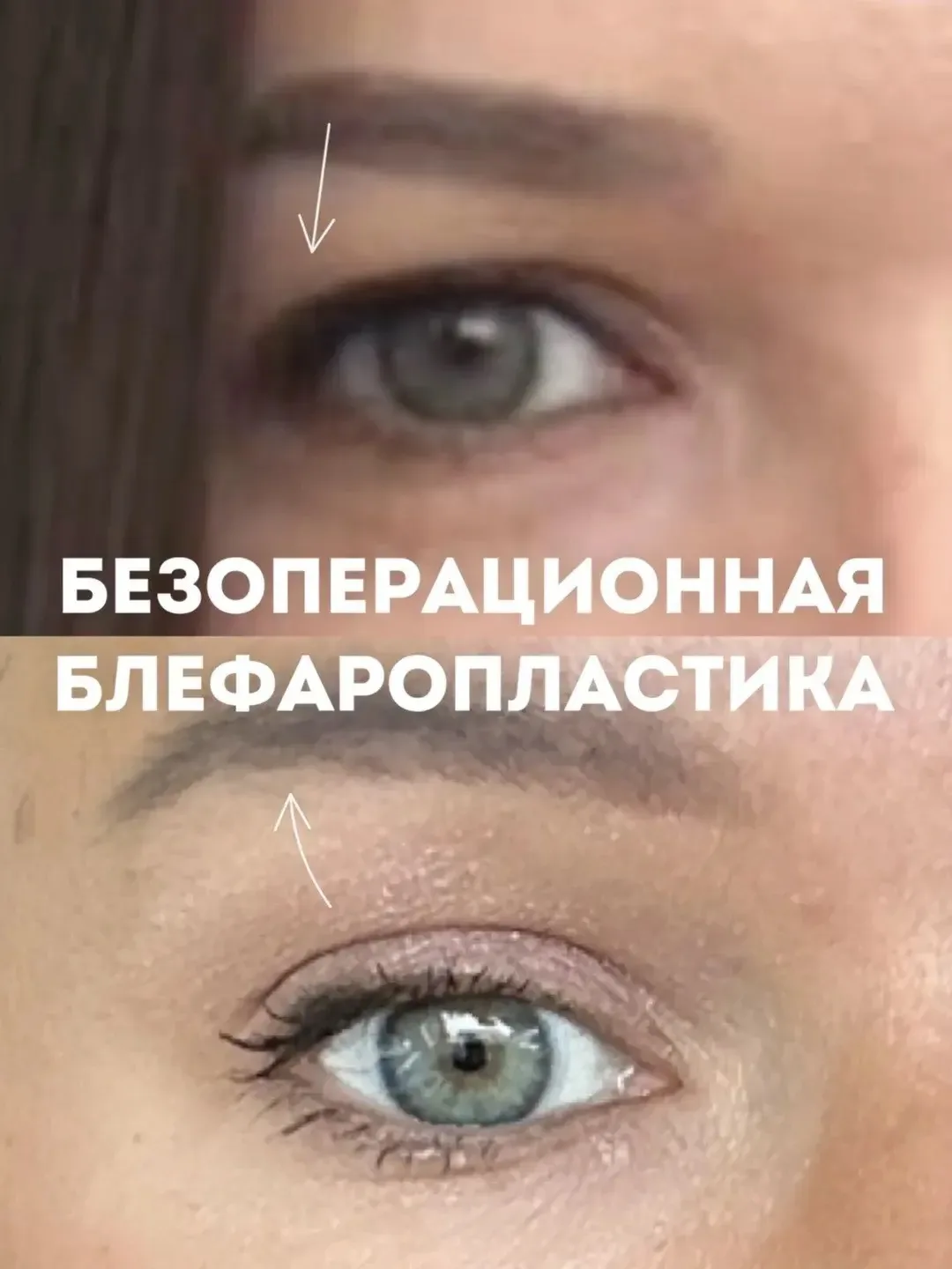 ПОДНЯЛИ НАВИСШИЕ ВЕКИ БЕЗ ОПЕРАЦИИ🔥