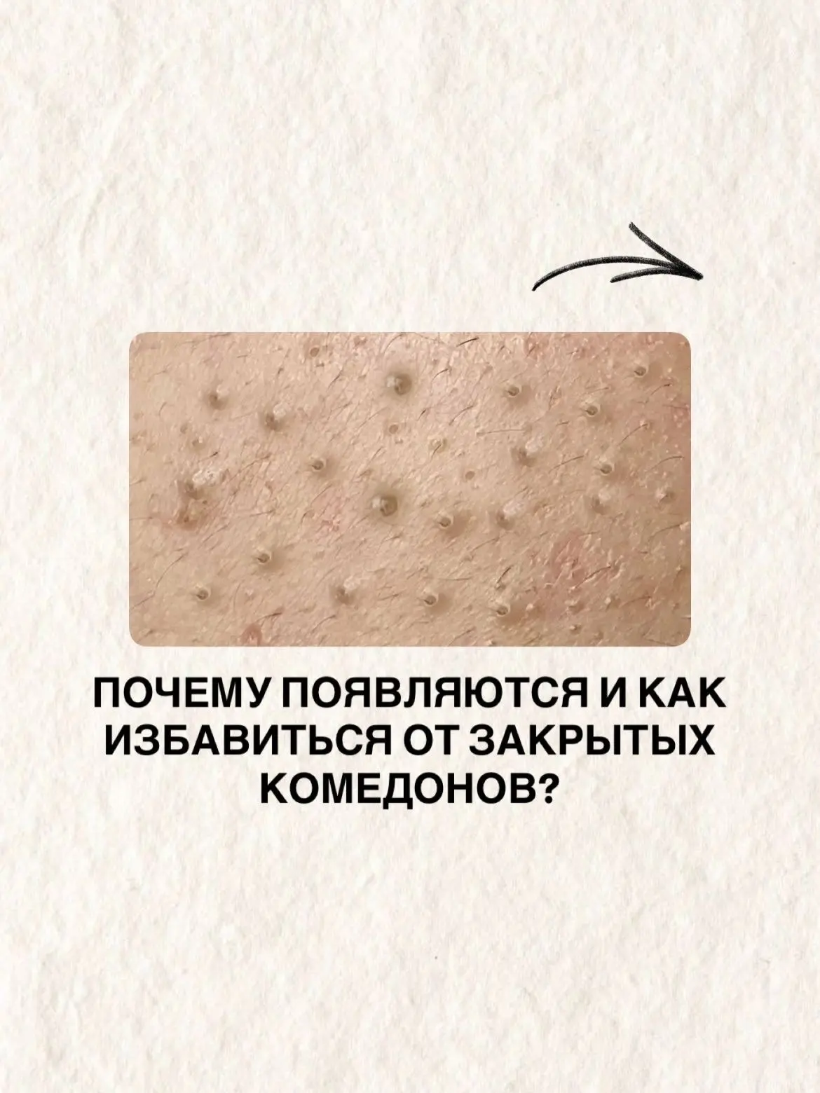 Почему появляются закрытые комедоны и как от них избавится👆🏻