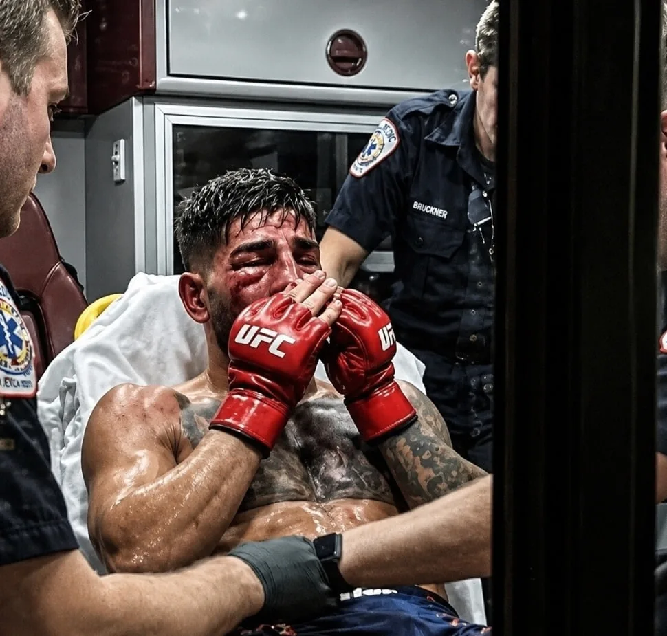 🩼 У бывшего чемпиона UFC в лёгком Илии Топурии диагностированы переломы обеих орбиталь...