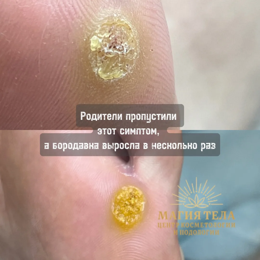 «Просто мозоль», «натёр обувью», «само пройдёт» — именно так чаще всего начинается исто...