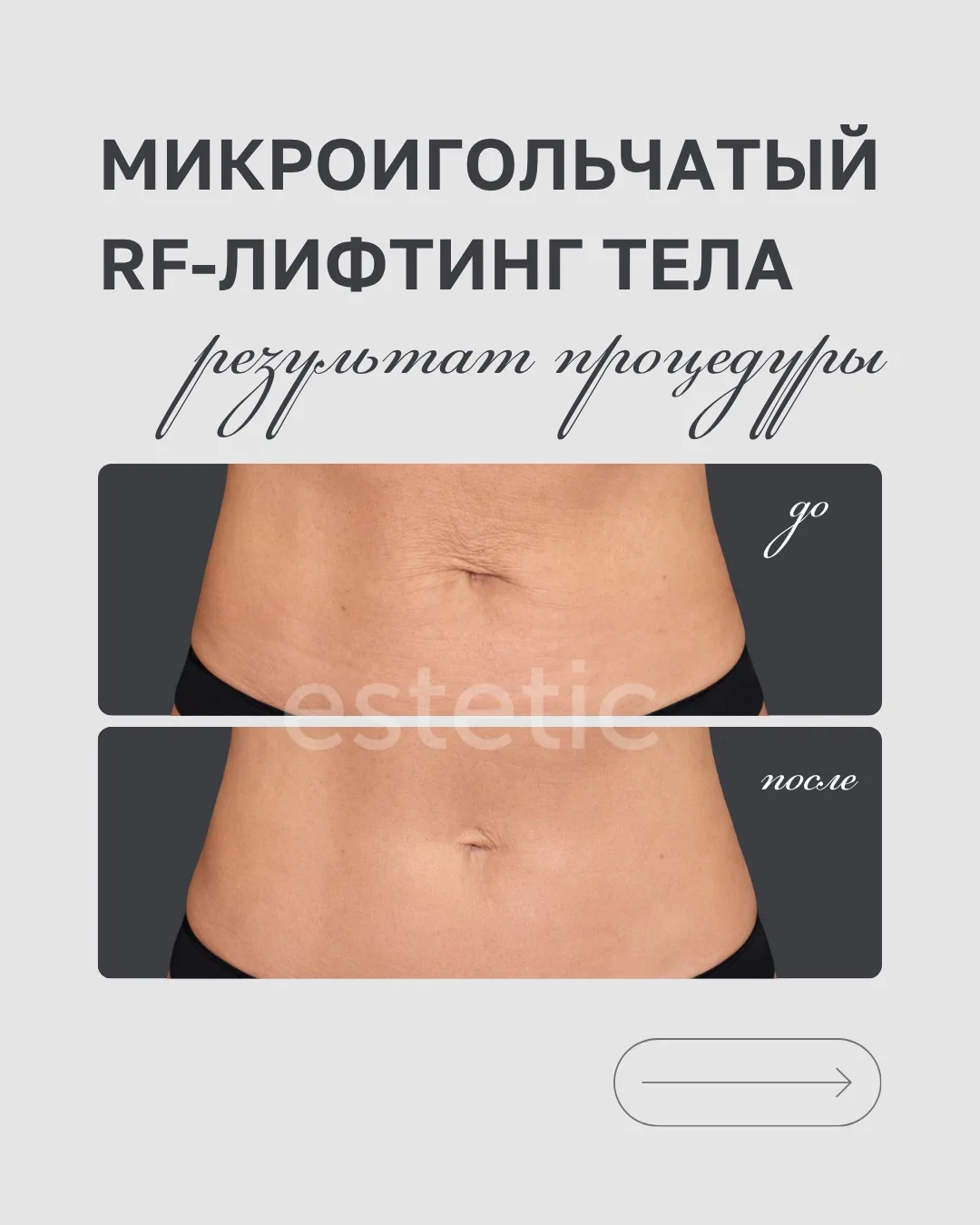 Вес ушёл, а тело всё равно не радует в зеркале?
