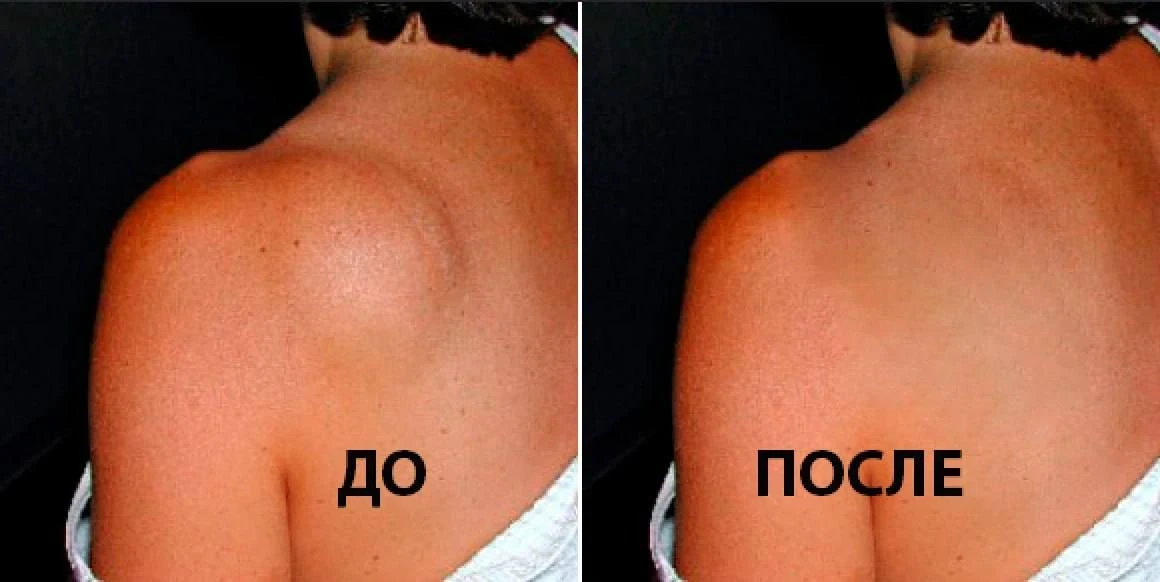❗️Резали дважды - а липома всё равно вырастала снова.