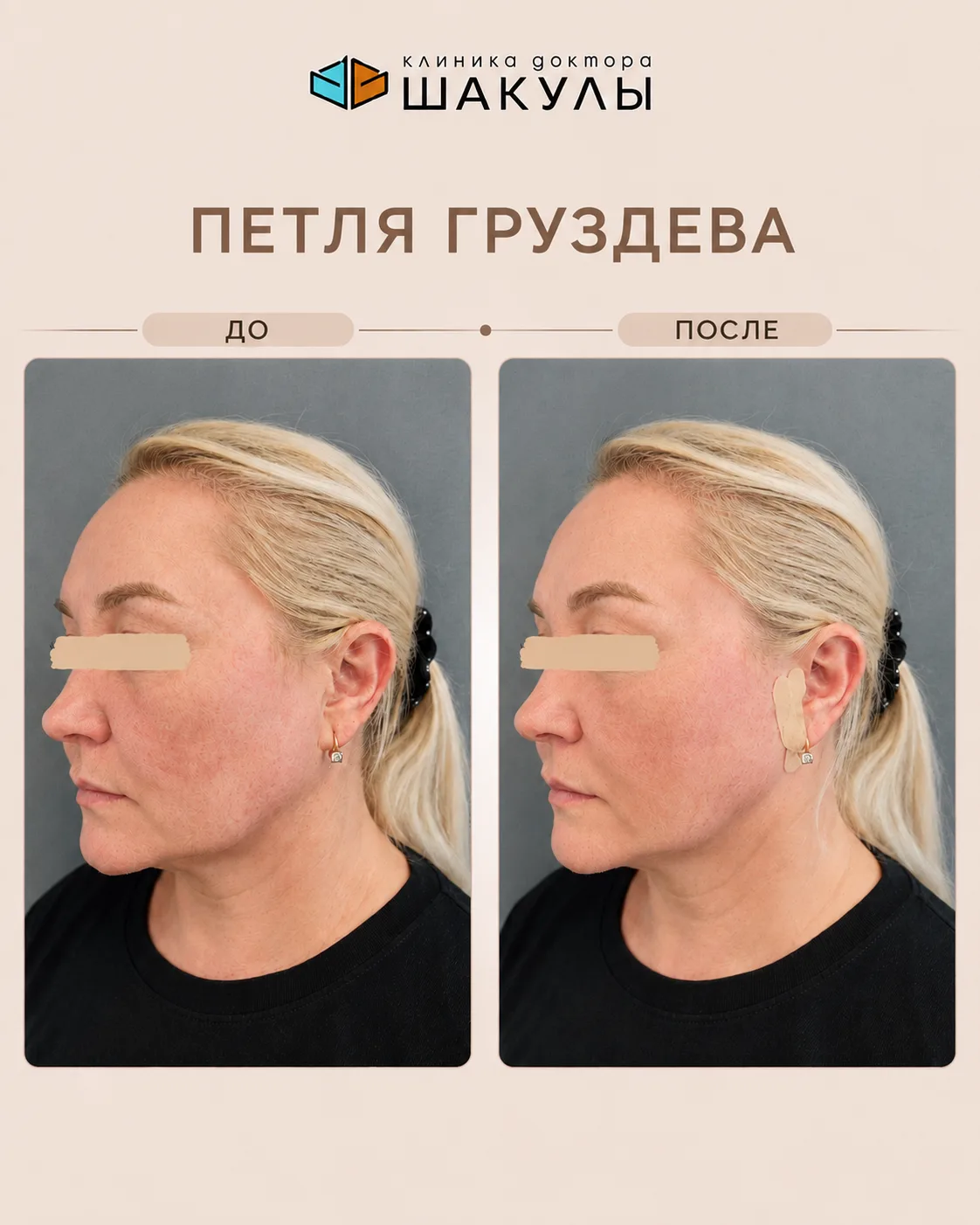 Постановка нитей по методике «Петля Груздева» ✨