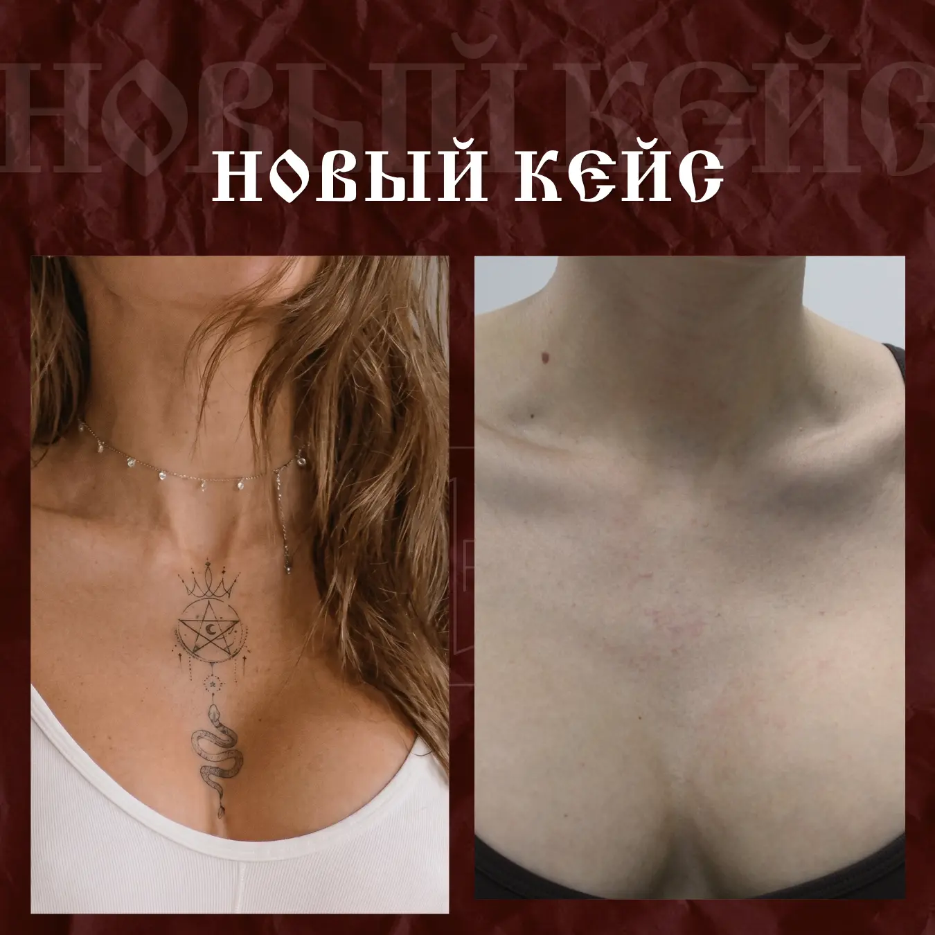 ⭐ Не все татуировки удаляют потому, что они были сделаны плохо.