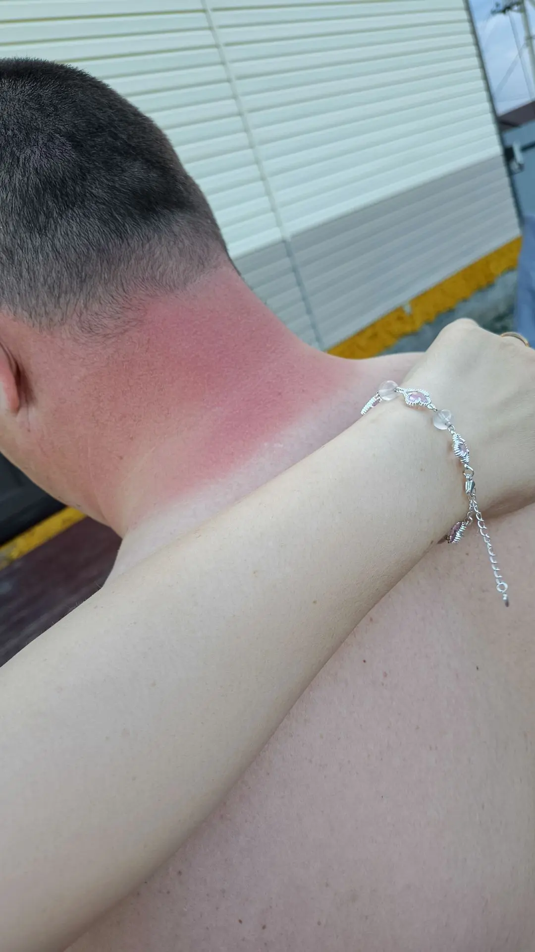 Муж провел пару часов на солнце. Я тоже 🤪