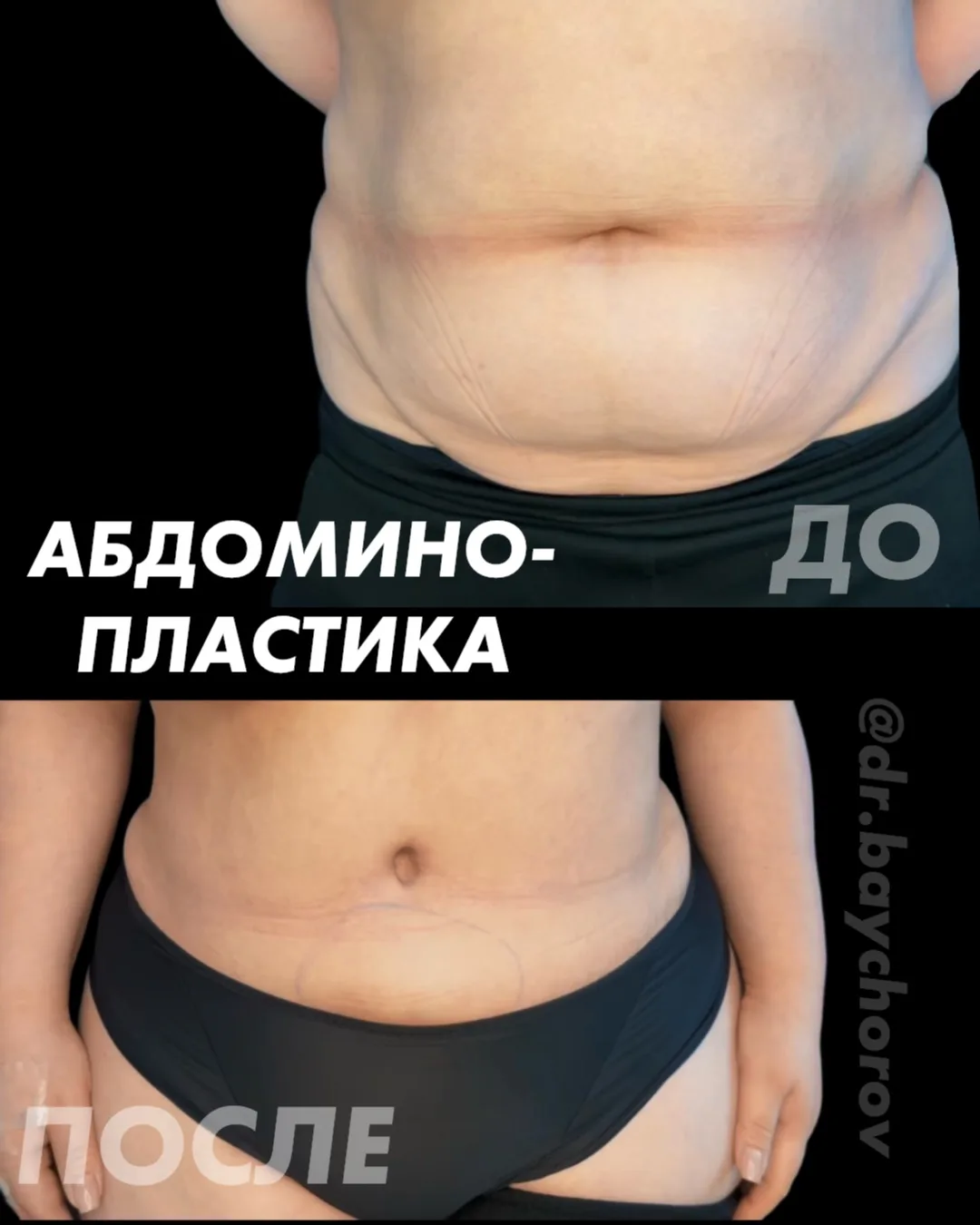 Живот, который больше не приходится прятать под одеждой