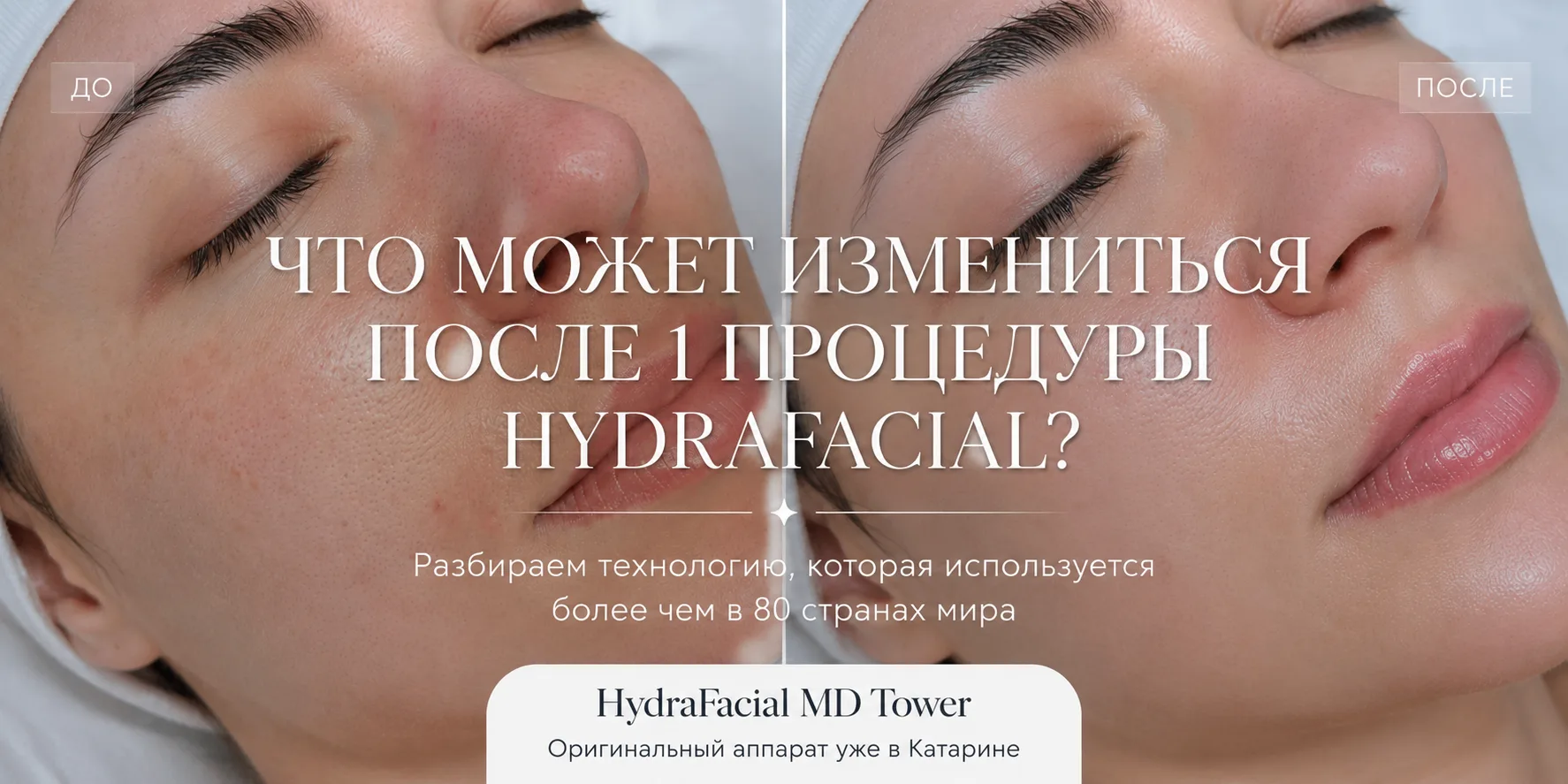 HydraFacial MD Tower: американская технология ухода за кожей, которую выбирают миллионы...
