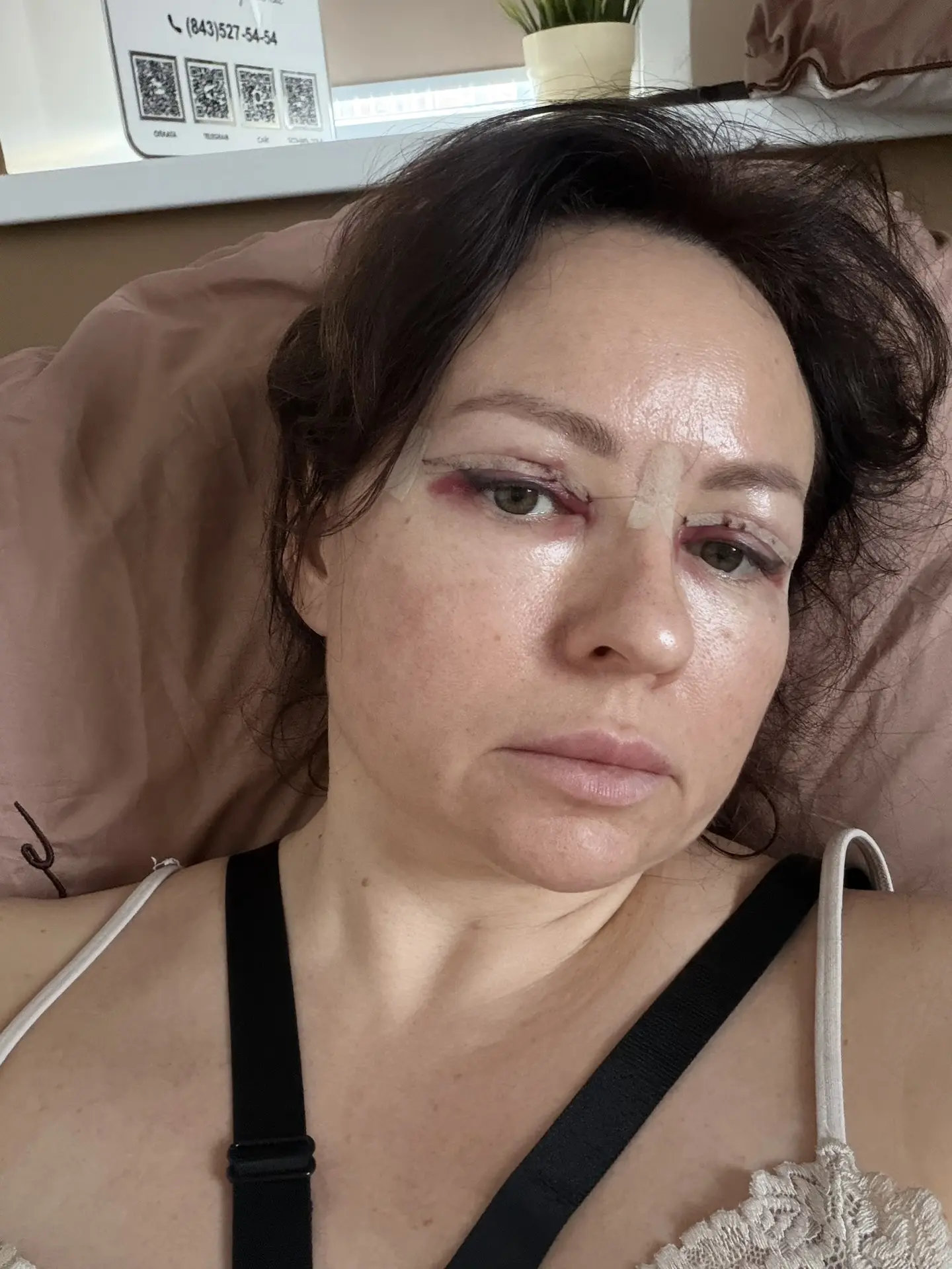 Девчата привет! Решила написать серию постов про операции , которые сделала месяц назад и уже виден 