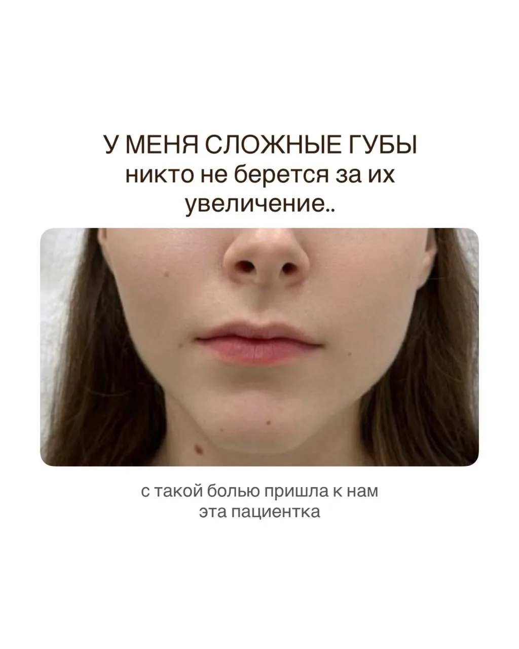 К Ольге Игоревне обратилась пациентка со сложной формой, которую еще называют "губы-чай...