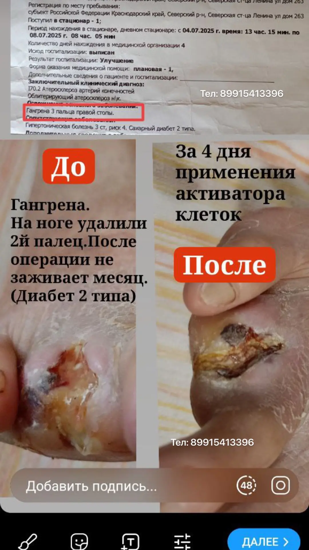 Отзыв. Гангрена