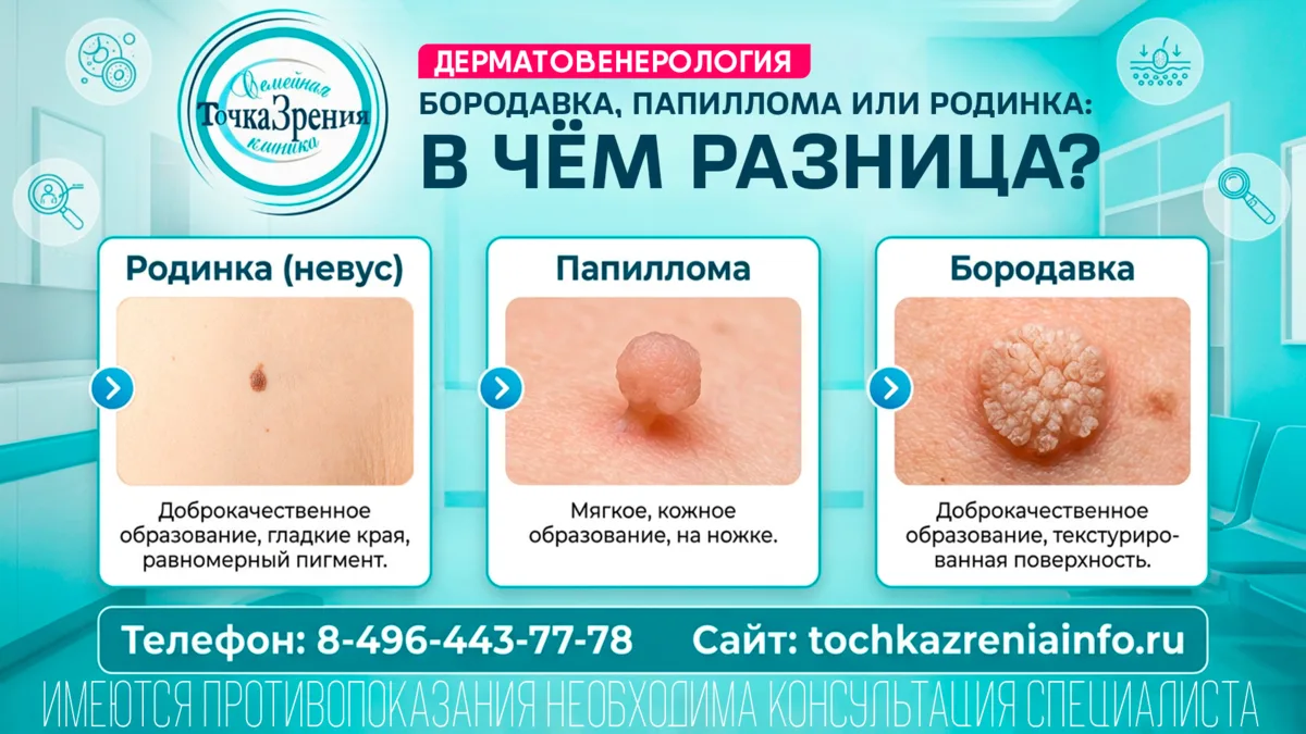 🔍 Бородавка, папиллома или родинка: в чём разница?
