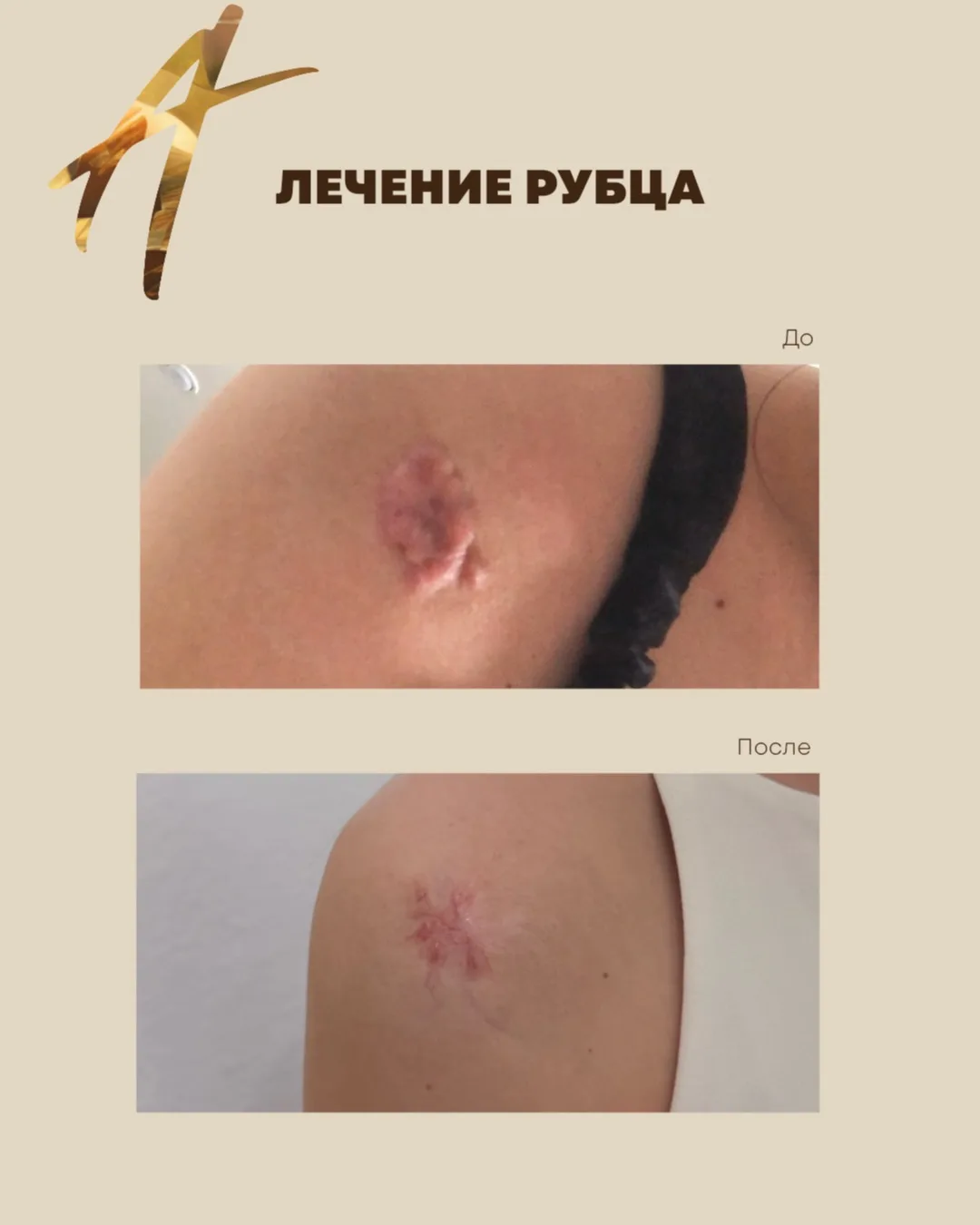 Лечение келлойдного рубца после падения с байка.