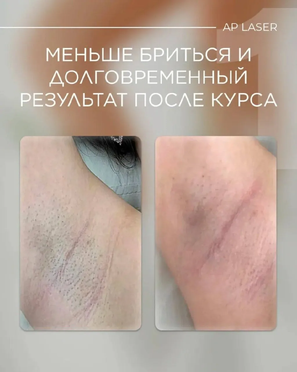 3 причины прийти на лазерную эпиляцию уже сейчас🙌🏻

Готовы попробовать?
Задать вопросы и узнать вс