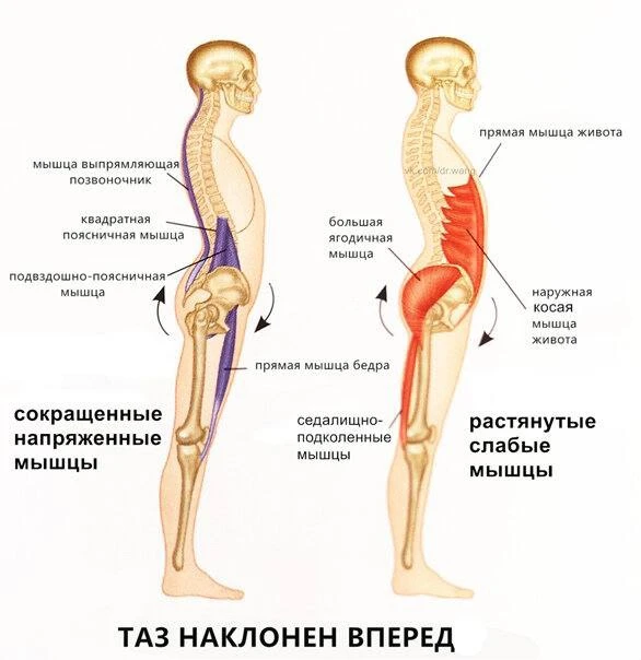 🎻 Как гиперлордоз мешает получать результаты от тренировок и как работать с такими клиентами?

Увер