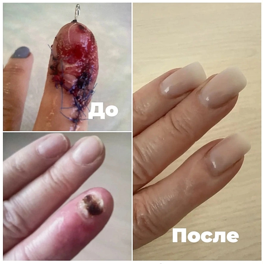 ⏳ Процесс восстановления занял около года. 

На фото: 
⦁ ДО - палец после после операции и установки