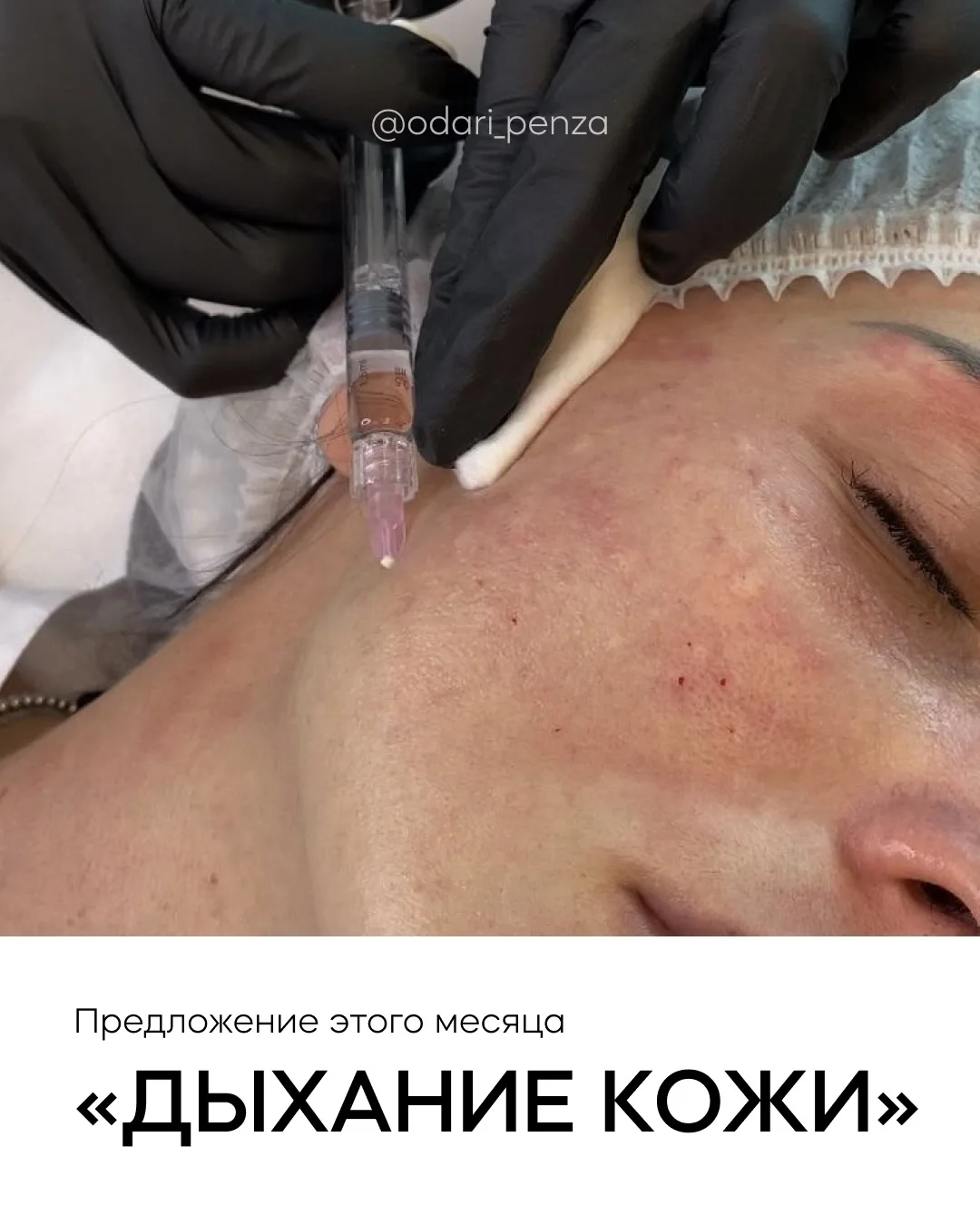 Биоревитализация по СКИДКЕ 🔥