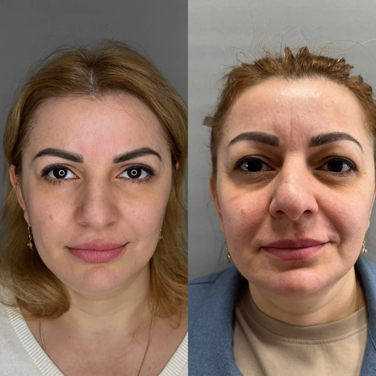 Блефаропластика и омоложение методом Full Face Lifting!