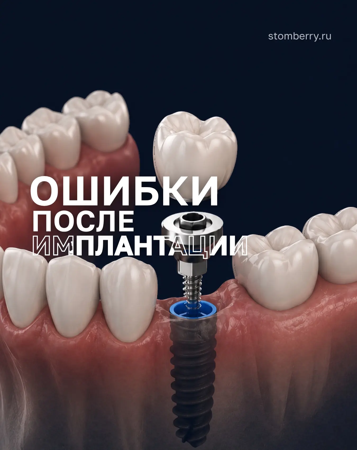 Ошибки после имплантации, которые могут свести результат на нет.