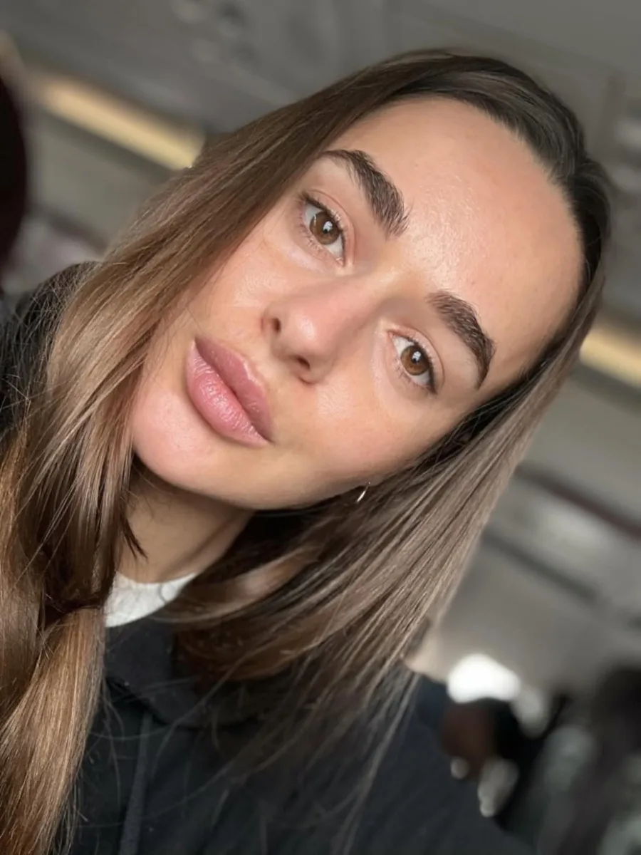 Отзыв после увеличения губ, листайте карусель 🤗 Заживший результат, 1мл Stylage M