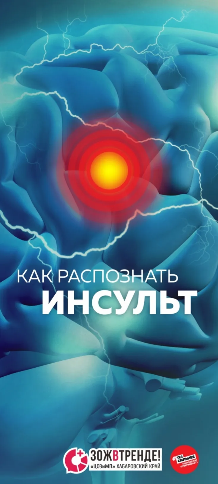 Инсульт: почему счёт идёт на часы и как не потерять драгоценное время