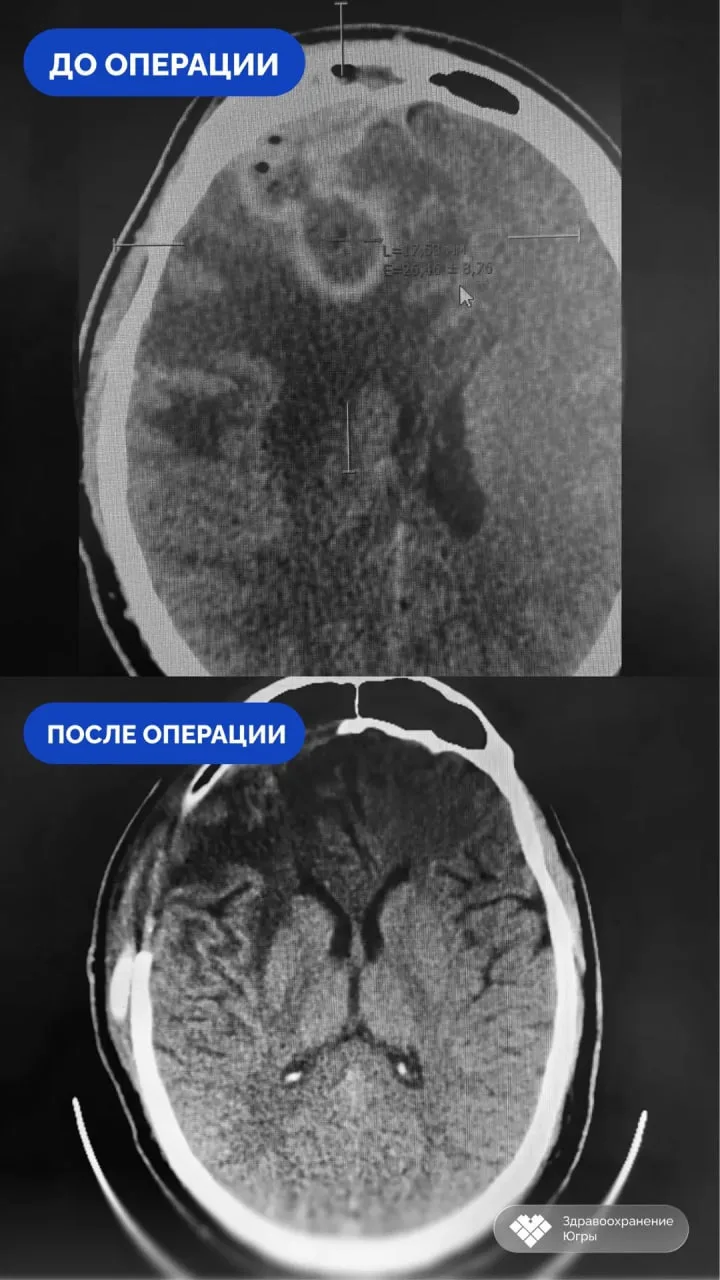 Самостоятельное лечение насморка привело к отеку головного мозга у 21-летнего жителя Су...