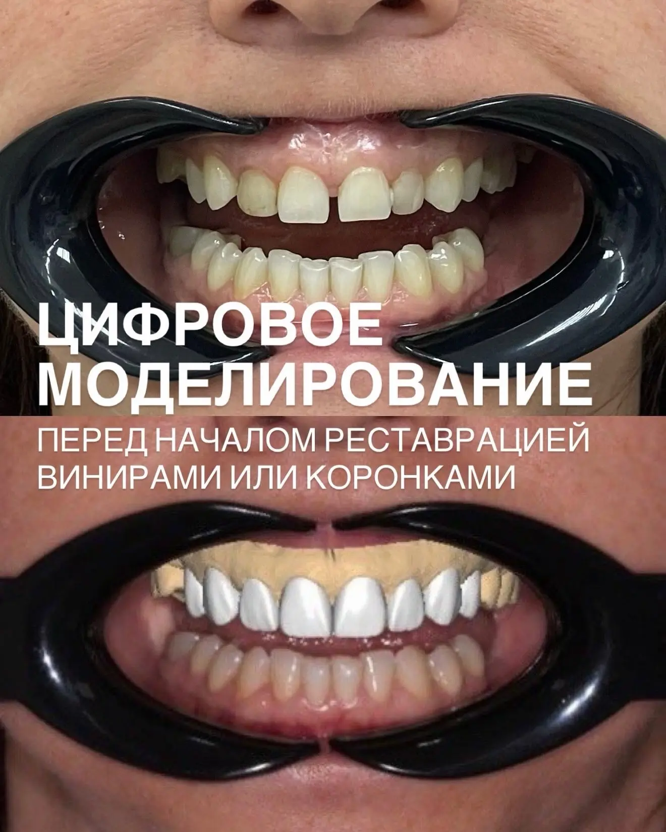 🔷Цифровое планирование улыбки - это возможность примерить будущую улыбку, для нас важн...