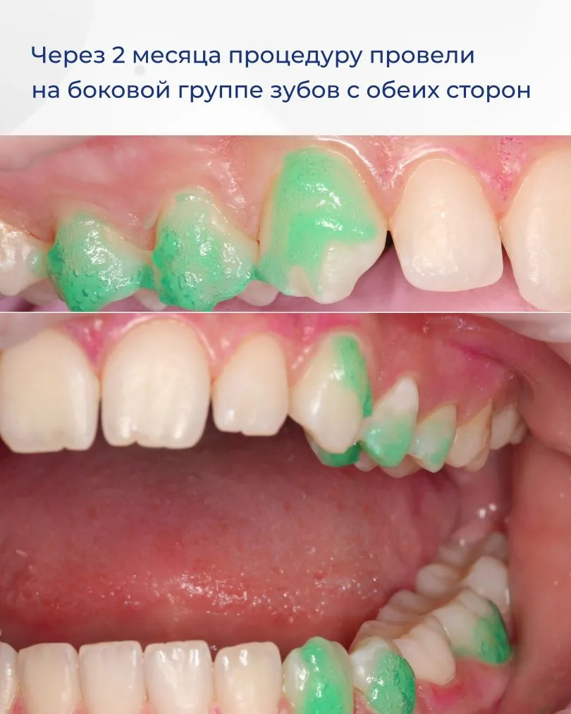 Устраняем дисколорит зубов за одну процедуру! Как это возможно? Сейчас расскажу! Пациентке 11 лет. Б
