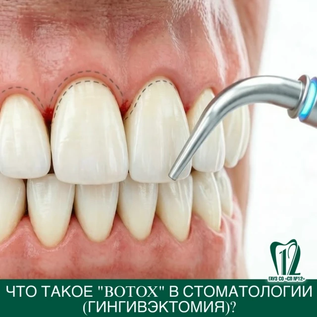 Что такое ”Botox”в стоматологии (Гингивэктомия)?