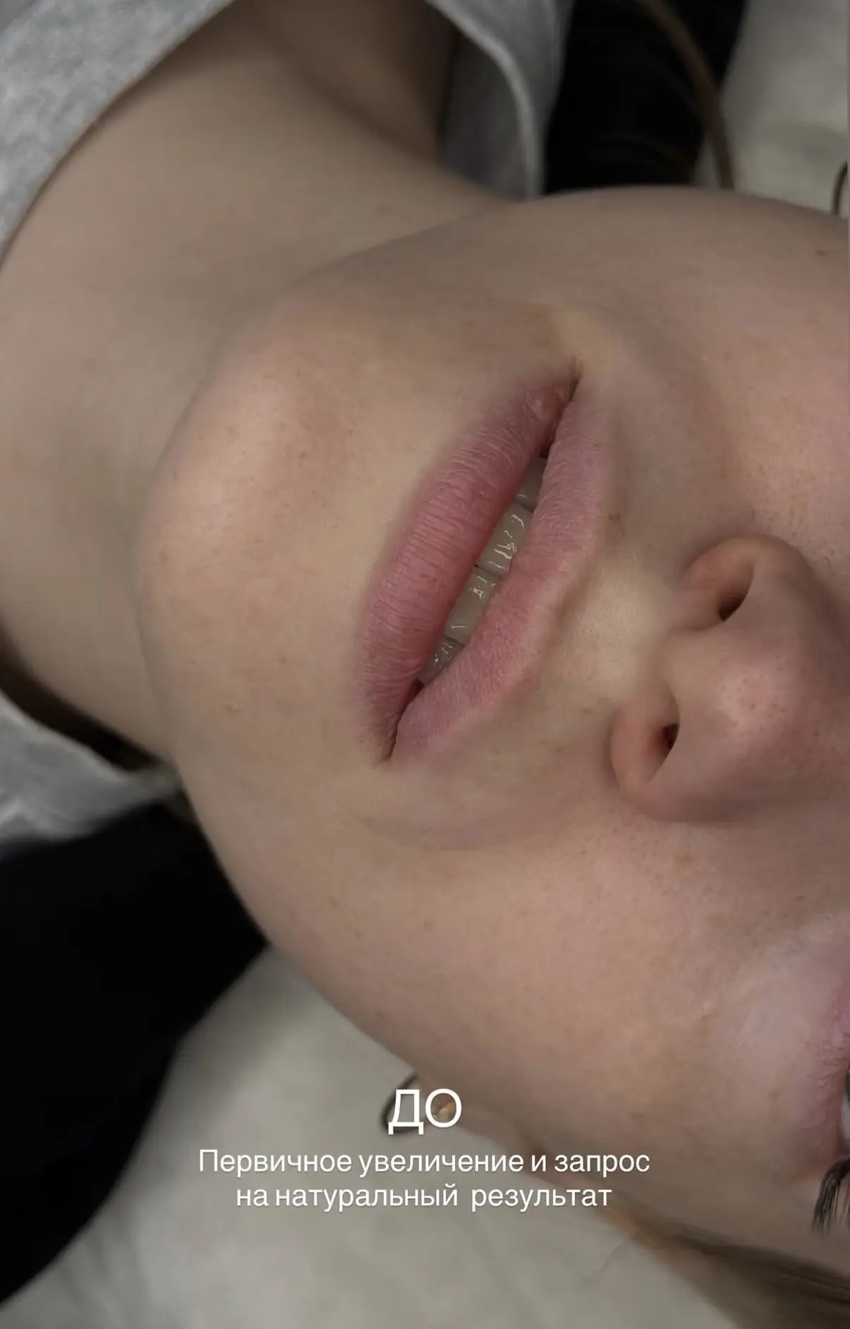 Увеличение губ 👄