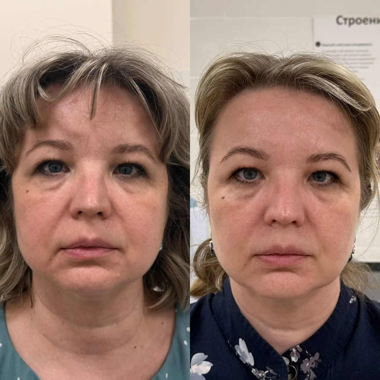 Результаты работы с программой Toning Peel Program:
Пациентка 49 лет

Сложное строение лица. Первое 