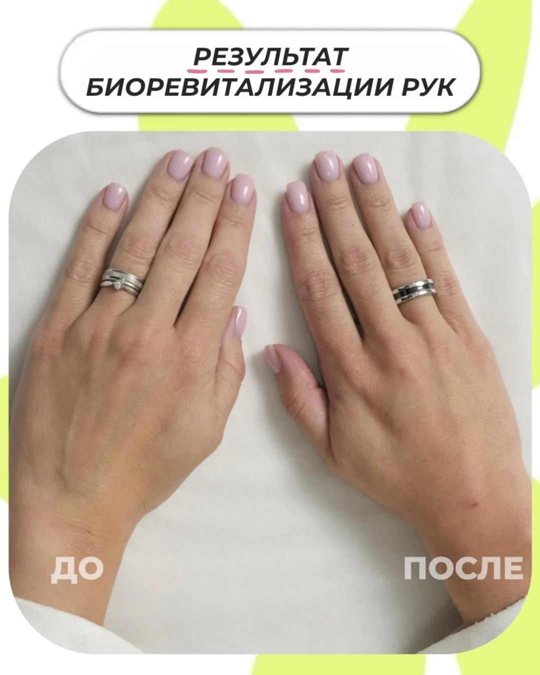 Морщинки, сухость, сосуды - что делать с кожей рук?