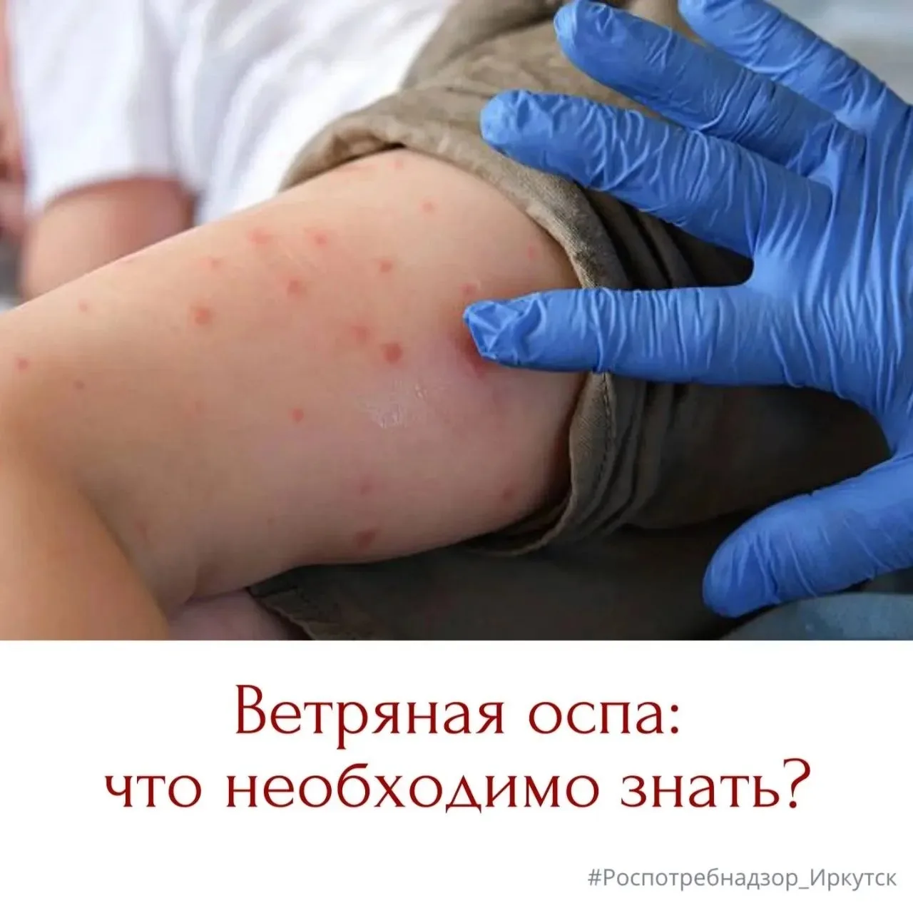 🦠 Ветряная оспа (или ветрянка) – острое, инфекционное заболевание. Риск заражения не п...