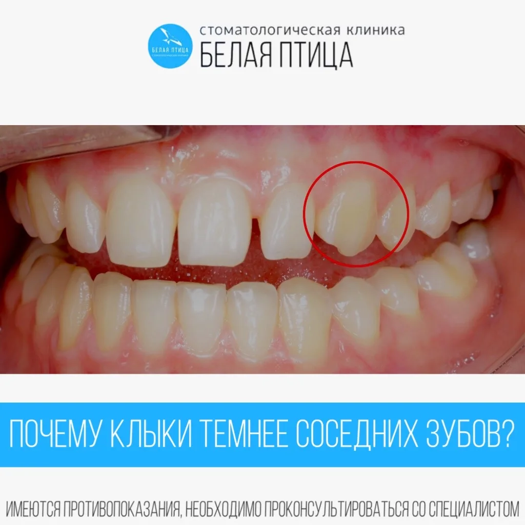 Многие из нас замечают, что клыки выглядят немного темнее или имеют более тёплый оттено...