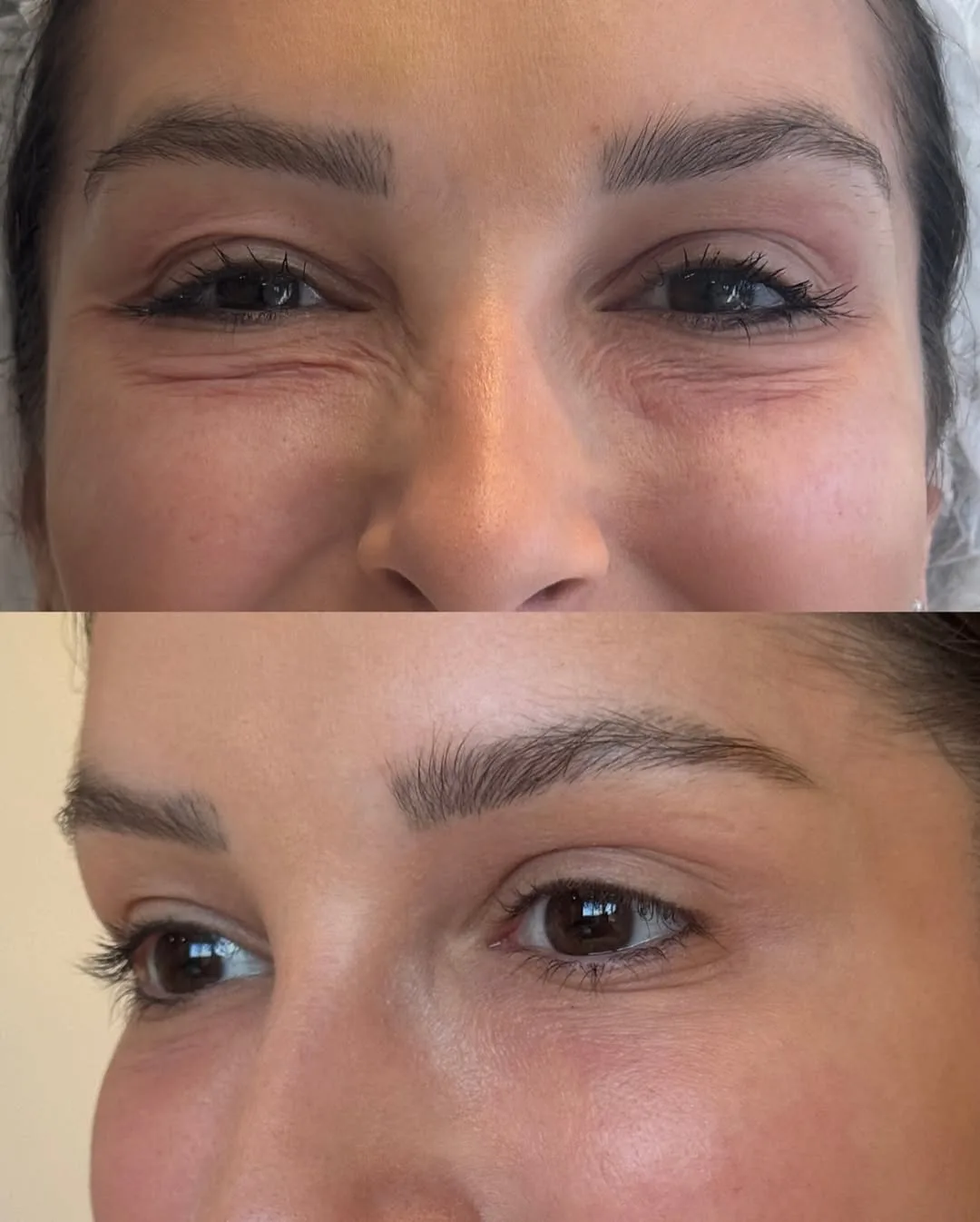 Результат после 3 процедур smooth eyes