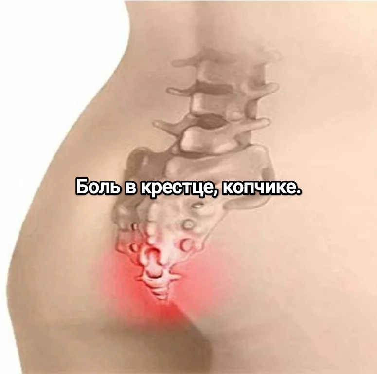 🔎 Клинический случай: 3 года боли в крестце и 3 месяца ада в копчике. Почему не помога...