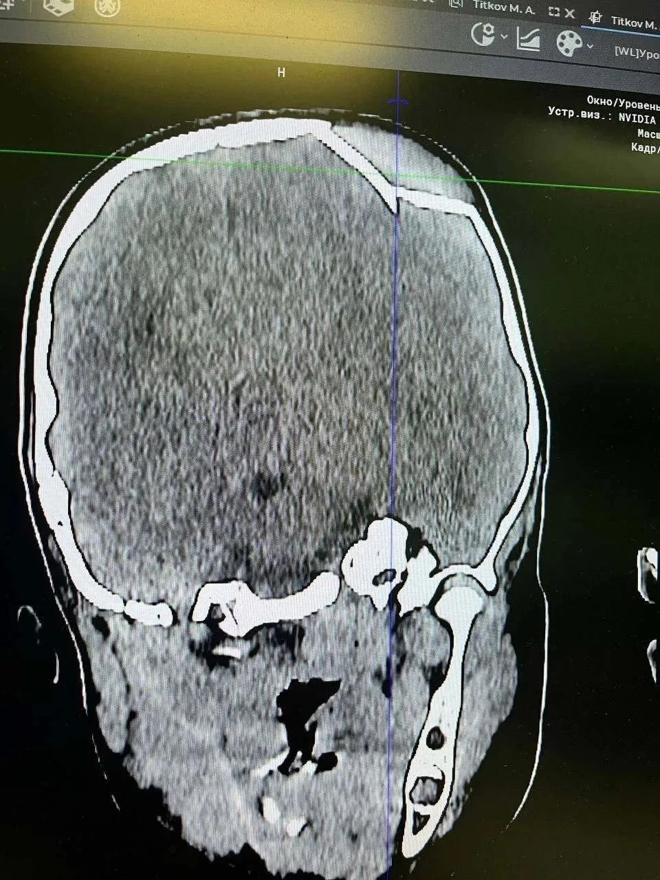 🙏 Саратовские хирурги спасли трехлетнего мальчика после падения с самоката