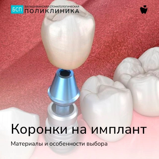 🦷 Коронки на имплант: материалы и особенности выбора